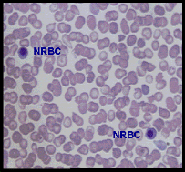 Nucleated RBC'S